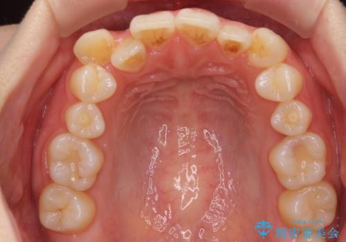 八重歯 歯を抜かずにマウスピース矯正で インプラント矯正で上の奥歯を後ろに移動の治療前