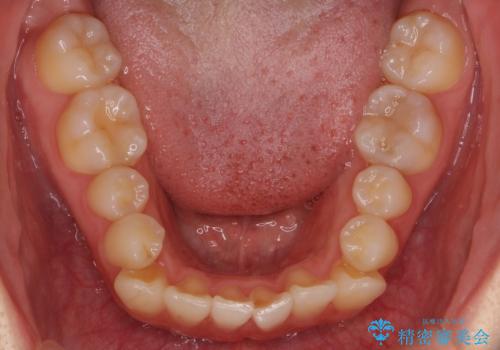 八重歯 歯を抜かずにマウスピース矯正で インプラント矯正で上の奥歯を後ろに移動の治療前