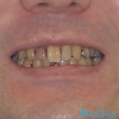 放置した歯列 矯正治療とインプラント治療で劇的に改善の治療前(顔貌)