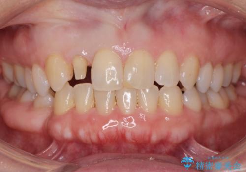 矮小(わいしょう)歯の形をセラミックで自然に 50代女性の治療中