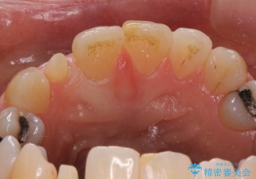 矮小(わいしょう)歯の形をセラミックで自然に 50代女性の治療中