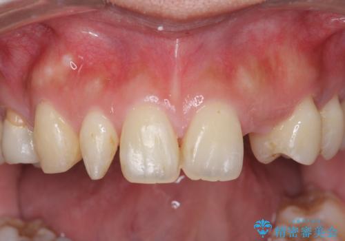 前歯の審美的なブリッジ (歯列矯正後)の治療前
