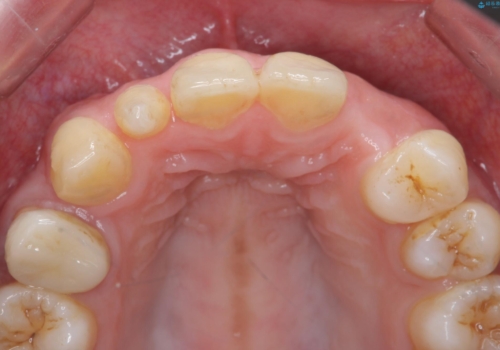 前歯の審美的なブリッジ (歯列矯正後)の治療前
