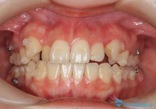八重歯 歯を抜かずにマウスピース矯正で インプラント矯正で上の奥歯を後ろに移動の治療中