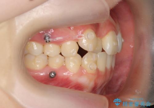 八重歯 歯を抜かずにマウスピース矯正で インプラント矯正で上の奥歯を後ろに移動の治療中