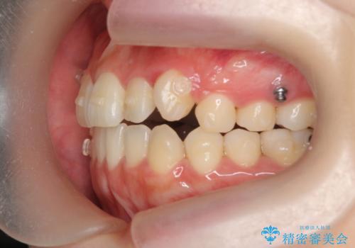 八重歯 歯を抜かずにマウスピース矯正で インプラント矯正で上の奥歯を後ろに移動の治療中