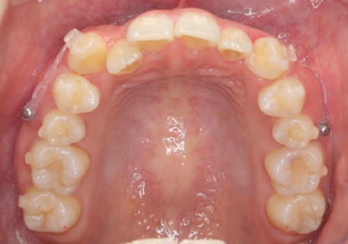 八重歯　歯を抜かずにマウスピース矯正で　インプラント矯正で上の奥歯を後ろに移動の治療中