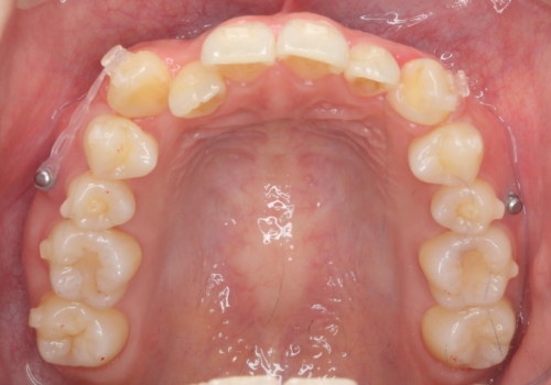八重歯 歯を抜かずにマウスピース矯正で インプラント矯正で上の奥歯を後ろに移動の治療中