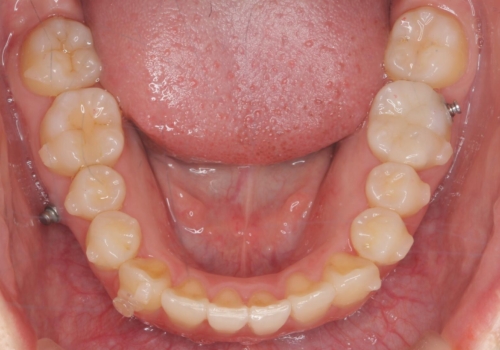 八重歯 歯を抜かずにマウスピース矯正で インプラント矯正で上の奥歯を後ろに移動の治療中