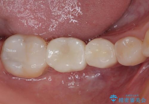 銀歯をやり替えたい。インプラントとセラミックによる治療の症例 治療後