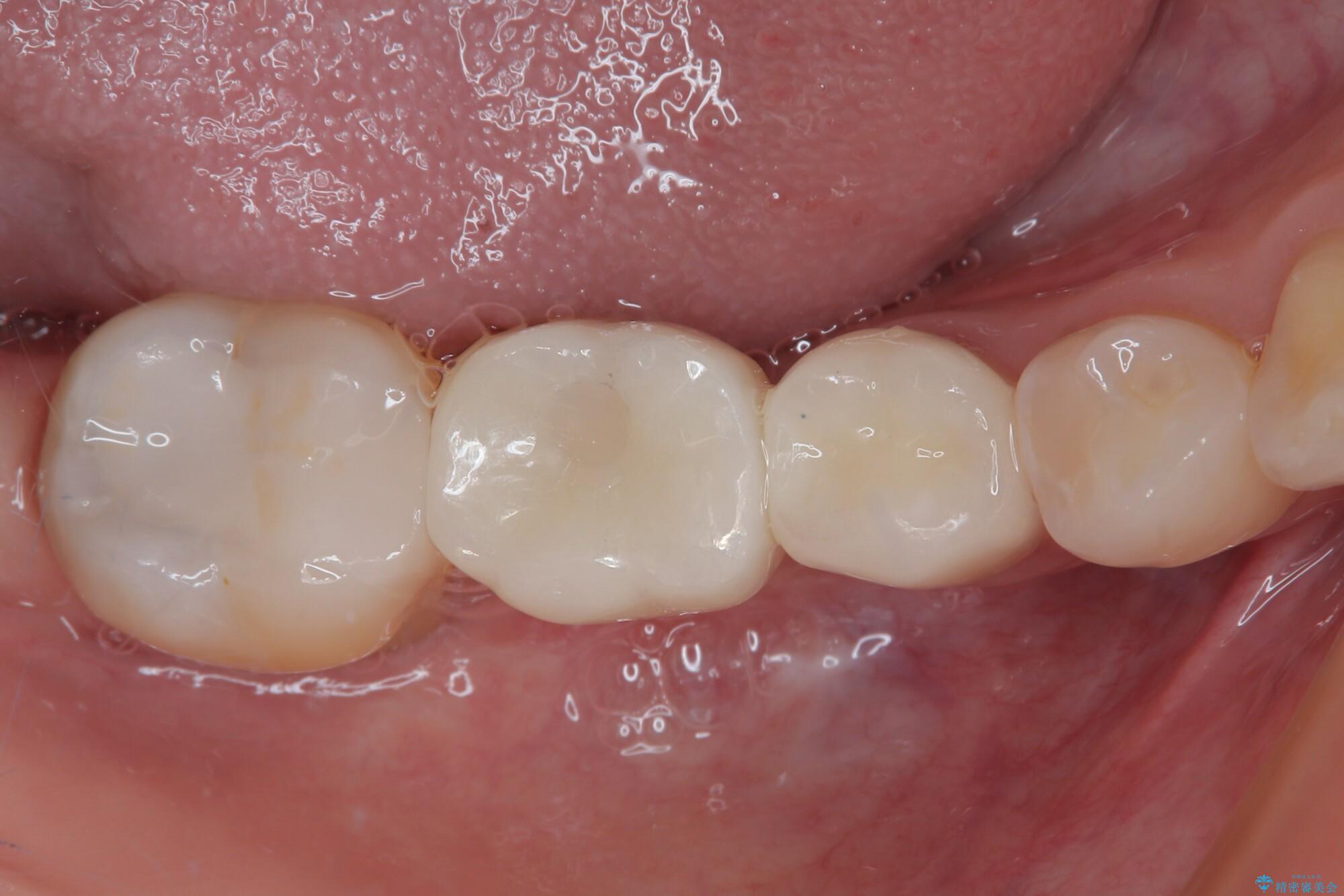 銀歯をやり替えたい。インプラントとセラミックによる治療｜（医）精密