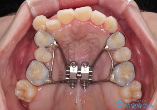 急速拡大装置　狭い歯列を拡大して短期間での矯正治療の治療中
