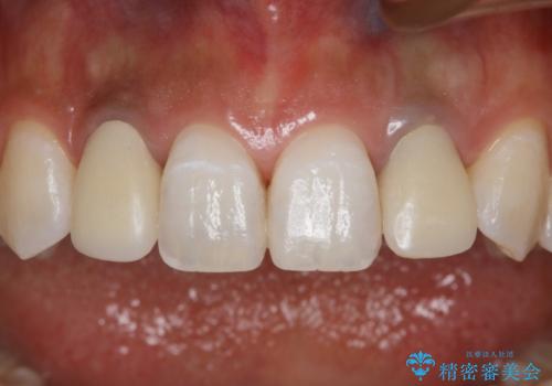 仮歯からセラミックへ 色合わせで自然な色調の再現の症例 治療前