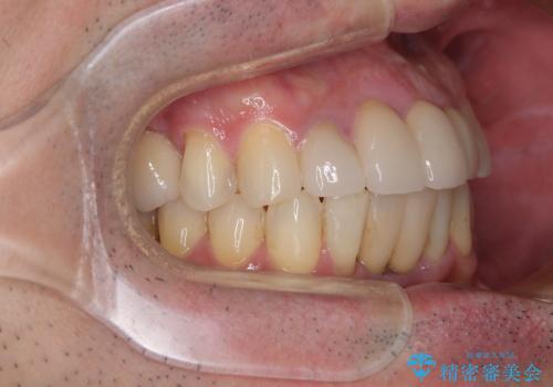 放置した歯列 矯正治療とインプラント治療で劇的に改善の治療後
