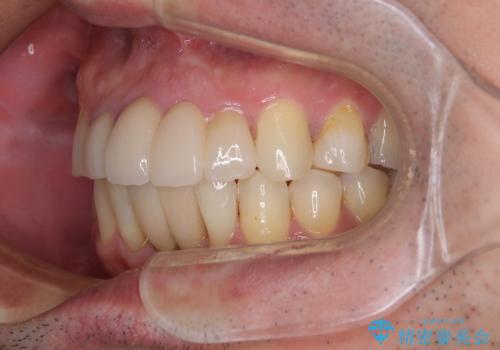 放置した歯列 矯正治療とインプラント治療で劇的に改善の治療後