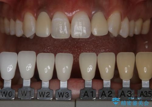 仮歯からセラミックへ　色合わせで自然な色調の再現