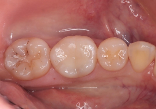 詰め物の下が黒いのが気になる　セラミックインレー修復の症例 治療後