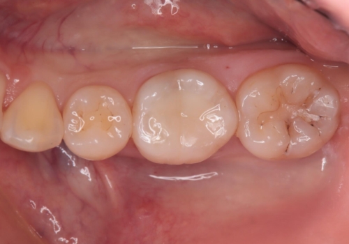 詰め物の下が黒いのが気になる　セラミックインレー修復