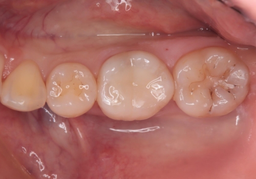 詰め物の下が黒いのが気になる セラミックインレー修復の治療後