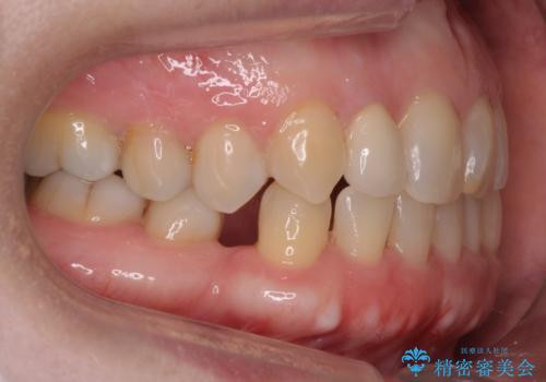 矮小(わいしょう)歯の形をセラミックで自然に 50代女性の治療後