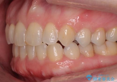 矮小(わいしょう)歯の形をセラミックで自然に 50代女性の治療後