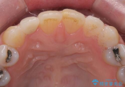 矮小(わいしょう)歯の形をセラミックで自然に 50代女性の治療後