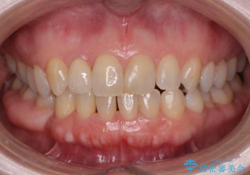矮小(わいしょう)歯の形をセラミックで自然に 50代女性の症例 治療後