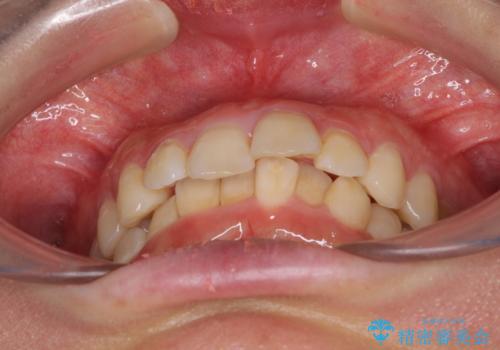 インビザラインが続けられない ワイヤー矯正に切り替えてデコボコを改善の治療前