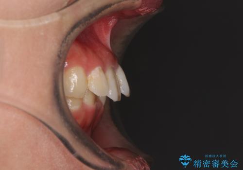 インビザラインが続けられない ワイヤー矯正に切り替えてデコボコを改善の治療前