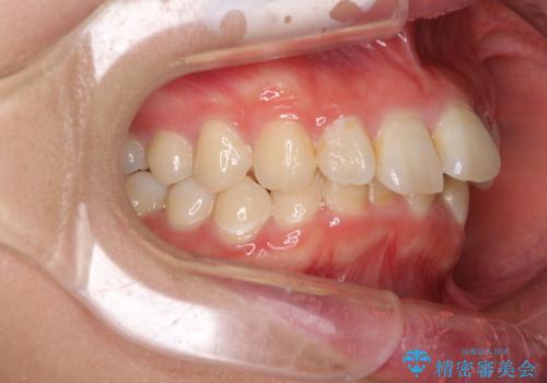 インビザラインが続けられない ワイヤー矯正に切り替えてデコボコを改善の治療前