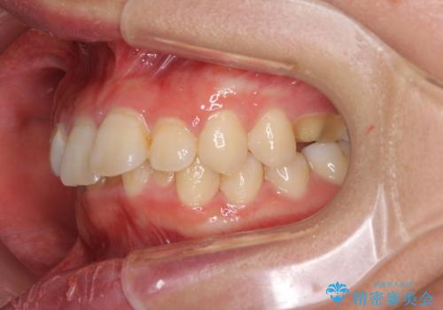 インビザラインが続けられない ワイヤー矯正に切り替えてデコボコを改善の治療前