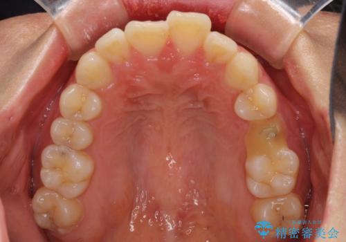 インビザラインが続けられない ワイヤー矯正に切り替えてデコボコを改善の治療前