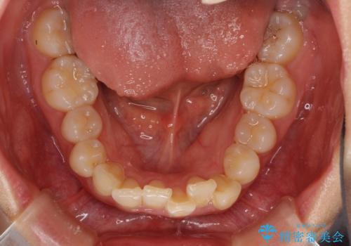 インビザラインが続けられない　ワイヤー矯正に切り替えてデコボコを改善の治療前