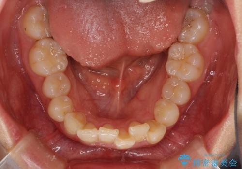 インビザラインが続けられない ワイヤー矯正に切り替えてデコボコを改善の治療前