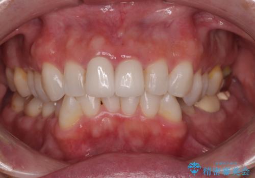 前歯の黄色味が気になる オールセラミッククラウン(スペシャル)の症例 治療後