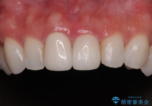 前歯の黄色味が気になる　オールセラミッククラウン(スペシャル)