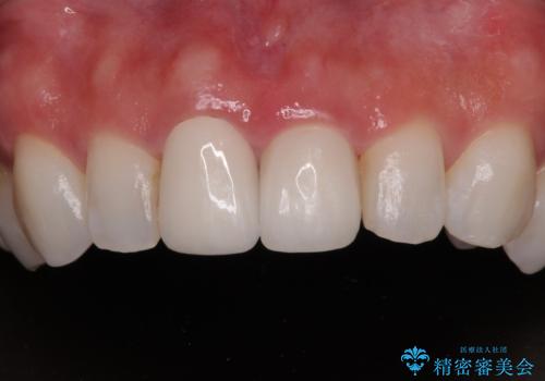 前歯の黄色味が気になる オールセラミッククラウン(スペシャル)の治療後