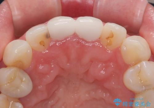 前歯の黄色味が気になる オールセラミッククラウン(スペシャル)の治療後