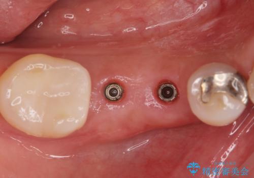 歯槽堤保存術 → インプラント治療の治療中