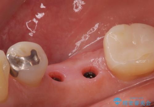 歯槽堤保存術 → インプラント治療の治療中