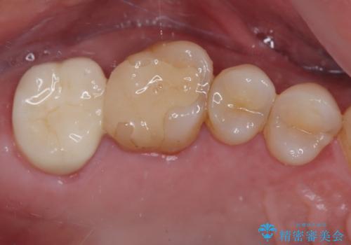 食事中に歯が欠けたので治したい。オールセラミッククラウンによる補綴の治療後