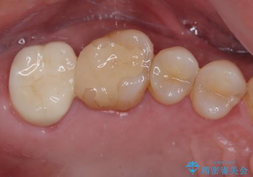 食事中に歯が欠けたので治したい。オールセラミッククラウンによる補綴の症例 治療後