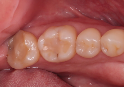 一時帰国　一日でセラミック修復の症例 治療前