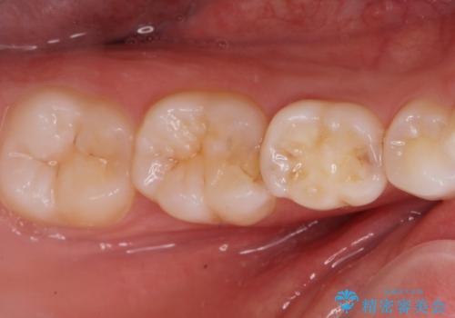 歯が染みる。セラミックインレー治療。の治療前