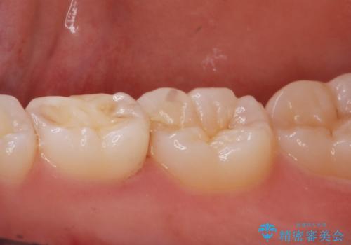 歯が染みる。セラミックインレー治療。の治療前