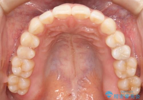 噛み合わせとガタつきの治療をインビザラインでの治療後