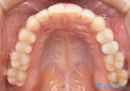 噛み合わせとガタつきの治療をインビザラインでの治療後