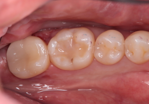 一時帰国　一日でセラミック修復の症例 治療後
