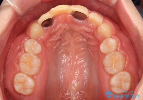 矯正治療中の仮歯を治したい オールセラミックブリッジ補綴治療の治療前