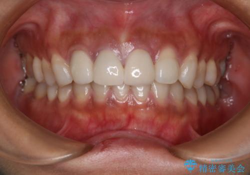 転んで歯をぶつけてしまった:前歯の色と形を改善したいの症例 治療後